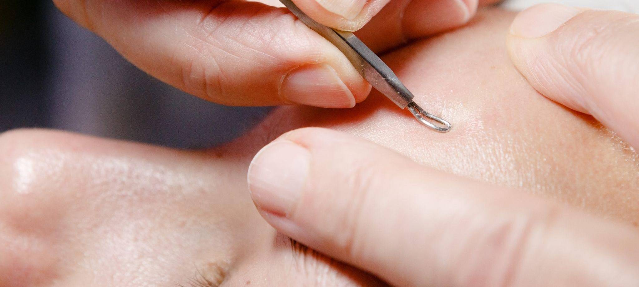 Kosmetikerin entfernt Pickel und Mitesser